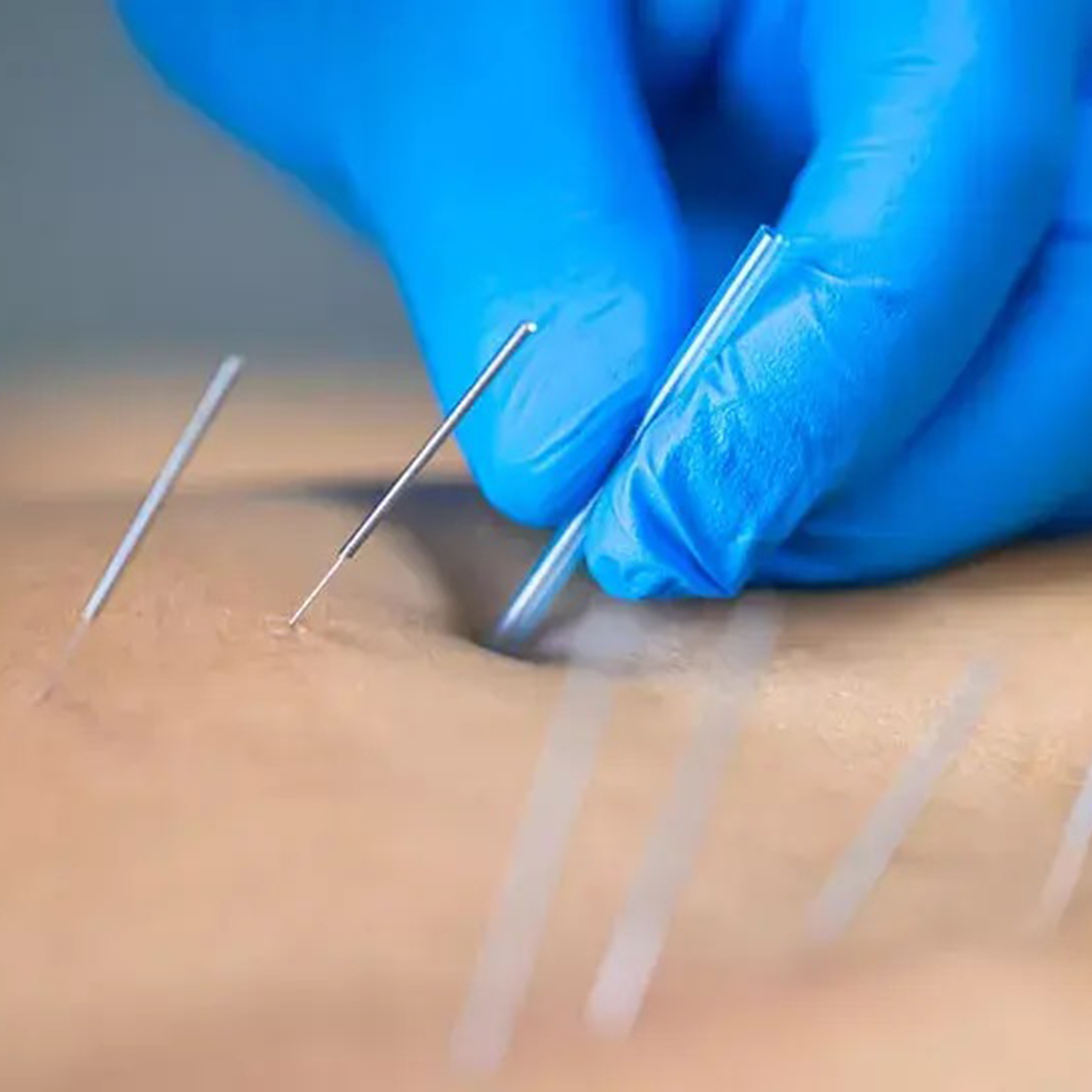 Dry Needling